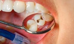 “Okul Çağındaki Çocukların Yüzde 60 İla Yüzde 90’ında Diş Çürüğü Görülüyor”