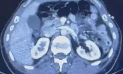 Midelerinde 554 Gram Uyuşturucu Bulunan 3 Şüpheli Yakalandı