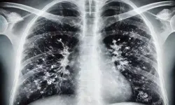 Kışın Solunum Yolu Enfeksiyonlarına Karşı Hijyen Uyarısı