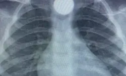 3 Yaşındaki Çocuk 50 Kuruşu Yutunca Hastaneye Kaldırıldı