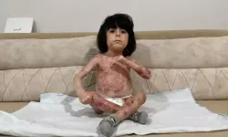 Bursa’da ‘Kelebek Hastası’ Çocuğa Yardım Çağrısı