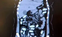 Midesinde 1,5 Kilo Metamfetaminle Yakalanan 2 Kadın Kurye Tutuklandı
