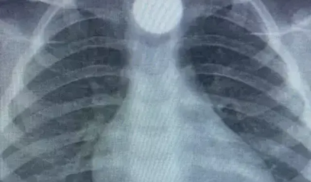 3 Yaşındaki Çocuk 50 Kuruşu Yutunca Hastaneye Kaldırıldı